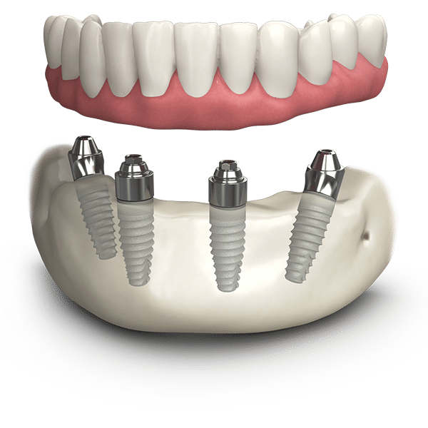 dental-implants